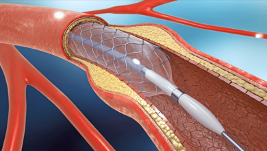 Drug-eluting Balloons | ICR Journal