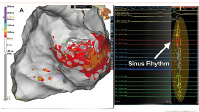 Functional Substrate Mapping of Ventricular Tachycardia