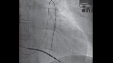 CardioMEMS Implantation Using Gadolinium-based Contrast Agent: A Case Report