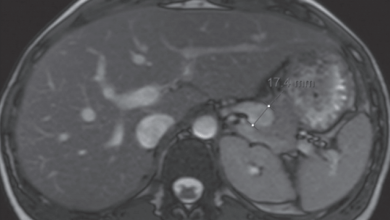 Conservative Management of a Splenic Artery Aneurysm in Pregnancy