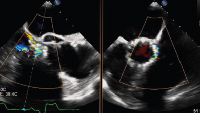 Imaging in Clinical and Subclinical Leaflet Thrombosis in TAVI