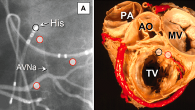Permanent Pacing of the Conduction Axis