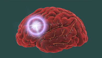 Impact of Catheter Ablation on Stroke, Cognitive Decline and Dementia