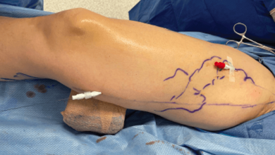Combined Treatment of the Anterior Accessory Saphenous Vein and the Great Saphenous Vein