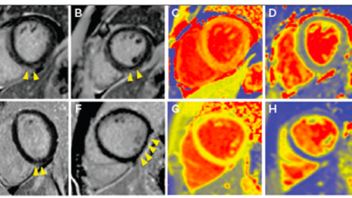 Cardiac Magnetic Resonance in the Evaluation of COVID-19