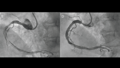Novel Mechanical Thrombosuction in an Ectatic Right Coronary Artery with Large Thrombus Burden: A Case Report