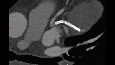 Intravascular Ultrasound-guided Versus Angiography-guided Percutaneous ...