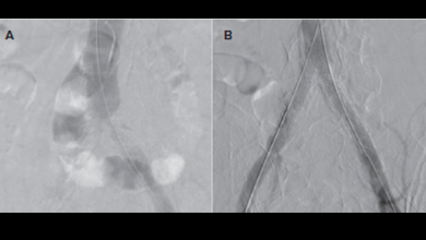 Stent Grafting for Aortoiliac Occlusive Disease: Review of the VBX FLEX Study