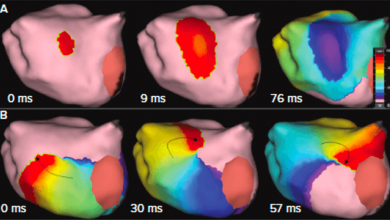 Global Substrate Mapping and Targeted Ablation with Novel Gold-tip Catheter