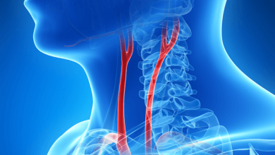 Does Current Evidence Support Carotid Artery Stenting for Asymptomatic Patients?