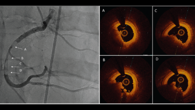 Role of Intracoronary Imaging in Acute Coronary Syndromes