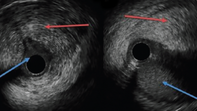 Complex Case of Pregnancy-related SCAD