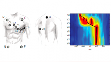Pacing-induced Cardiomyopathy and Ventricular Dyssynchrony Assessment
