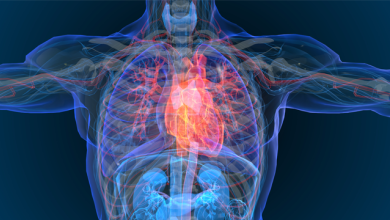 Sudden Cardiac Death in Ischaemic Cardiomyopathy