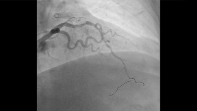 Severe Acute Thrombocytopenia After Tirofiban