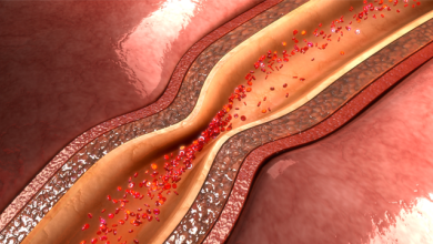 Evolution of Coronary Artery Spasm