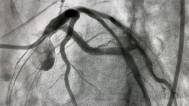 Coronary Artery Fistula: A Diagnostic Dilemma