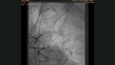 Iatrogenic LIMA Dissection during Radial Artery Graft PCI