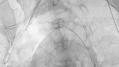 Placement of the Sheath into the Aortic Arch for Delivery of the ProtEmbo