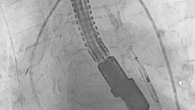 Removal of the Delivery System for the Second Transcatheter Heart Valve