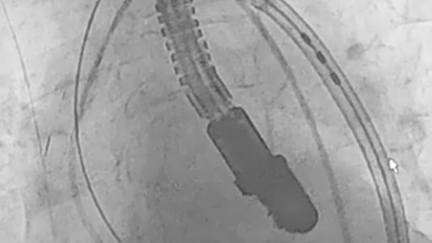 Crossing of the Second Transcatheter Heart Valve System