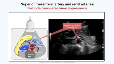 Abdominal Aorta Ultrasound: The SMA