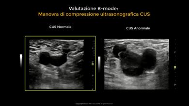 Manovra Di Compressione Ultrasonografica per La Diagnosi Di Trombosi Venosa Profonda (CUS)
