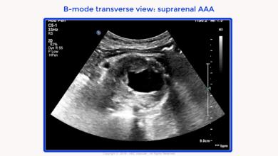 Suprarenal abdominal aortic aneurysm (AAA) in a patient with a previous infrarenal AAA repair with tube graft
