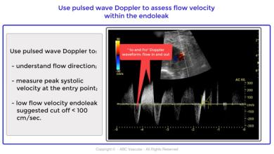 High jet velocities type II endoleak post endovascular abdominal aortic aneurysm repair (EVAR)