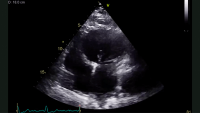 Supplementary Material Video 2: Isolated Left Ventricular Apical Hypoplasia