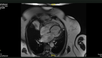 Supplementary Material Video 3: Isolated Left Ventricular Apical Hypoplasia