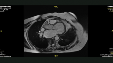 Supplementary Material Video 5: Isolated Left Ventricular Apical Hypoplasia