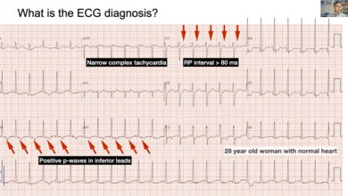 APSC Fellows Teaching Course: Save a life! Complex ECG Reading