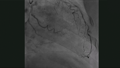 Coronary Intravascular Lithotripsy in the Presence of Left Main Haematoma - Supplementary Material Video 1