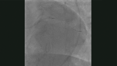 Coronary Intravascular Lithotripsy in the Presence of Left Main Haematoma - Supplementary Material Video 2