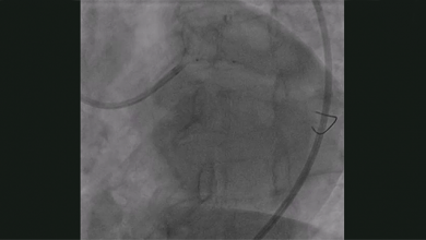 Coronary Intravascular Lithotripsy in the Presence of Left Main Haematoma - Supplementary Material Video 4