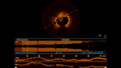 Coronary Intravascular Lithotripsy in the Presence of Left Main Haematoma - Supplementary Material Video 6