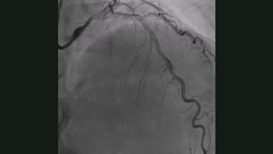 Coronary Intravascular Lithotripsy in the Presence of Left Main Haematoma - Supplementary Material Video 7