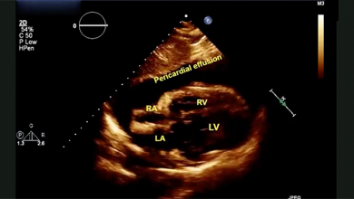 Cardiac Sarcoidosis, Pericardial Effusion and Stress-induced Cardiomyopathy: Supplement Video 6