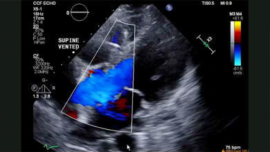 Supplementary Video 1: Clozapine-Induced Cardiomyopathy: A Case Report