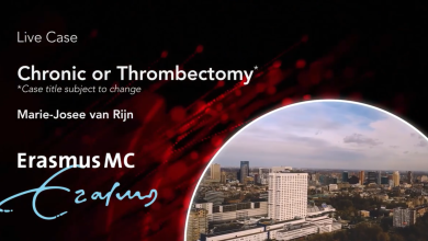 Thrombectomy Case
