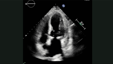 Video 2: Transthoracic Echocardiogram Shoring Apical Four-chamber View with Contrast