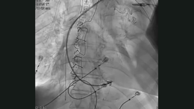   Stylet Driven Leads or Lumenless Leads for Conduction System Pacing: Supplementary Video 1