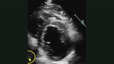 Two-dimensional Echocardiography