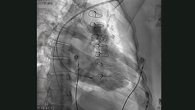 Video 1: Real-time visualisation of the pacing lead using electroanatomical mapping