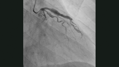 Video 3: An illustration of LAD artery ectasia with a visible clot