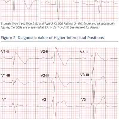 Figure 1 Brugada Type ECG Patterns