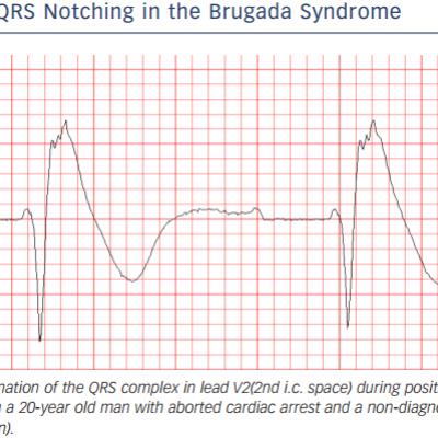 Figure 3 QRS Notching in the Brugada Syndrome