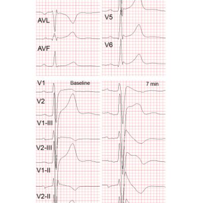 Figure 4 Early Repolarisation in the Brugada Syndrome