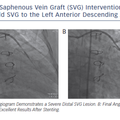Figure 1 Saphenous Vein Graft SVG Intervention of a&ampltbr /&ampgt&amp1020-year-old SVG to the Left Anterior Descending Artery
